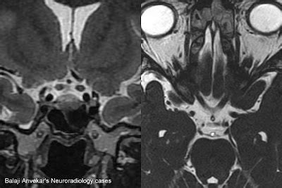 Dr Balaji Anvekar FRCR: Optic Nerve Atrophy MRI