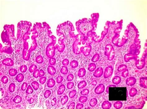 Using Marsh Scores To Diagnose Celiac Disease