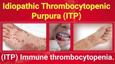 ITP idiopathic thrombocytopenic purpura immune thrombocytopenia bleeding blue spots homeopathy ...