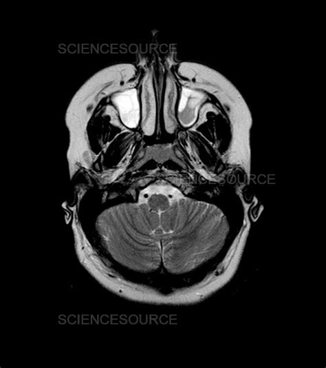 Mri Of Maxillary Sinusitis Stock Image Science Source Images