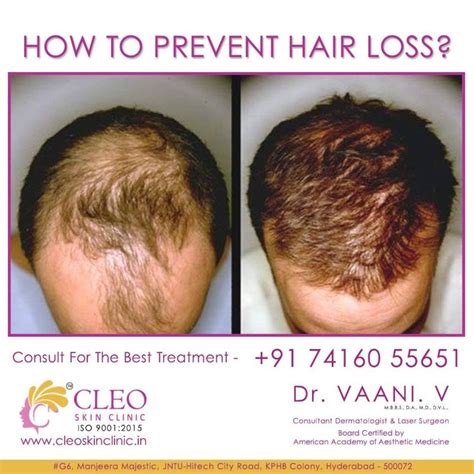 Dermatologist For Hair Loss Near Me Hair Loss