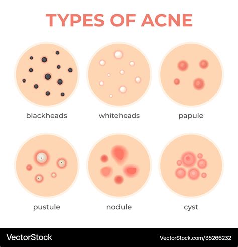 Acne Types Skin Infection Problem Pimples Grade Vector Image