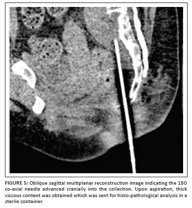 High Presacral Collection Approached Through The Perineal Route A