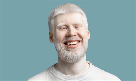 Why do albinos have white hair?