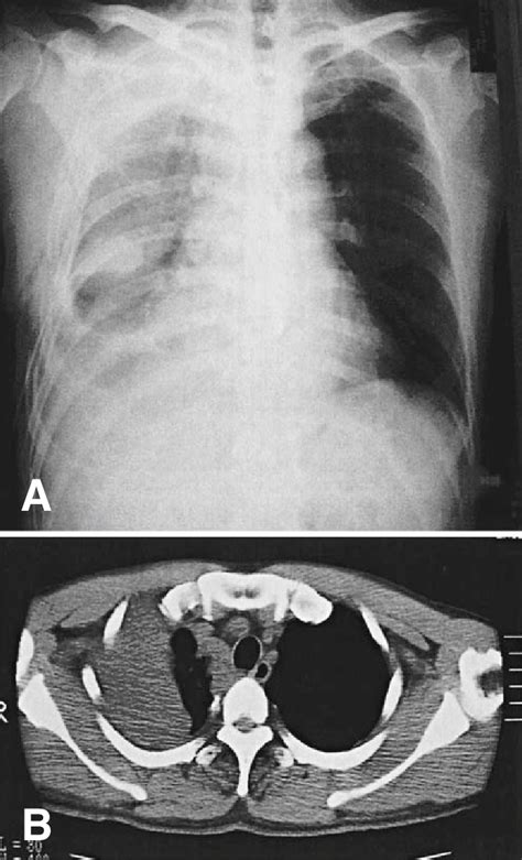 Chest Radiograph A Showing Hematoma Fi Lling The Right Thorax B CT