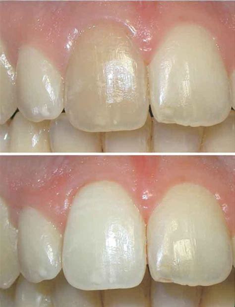 Internal Bleaching Nicole Mermet DMD Dentist