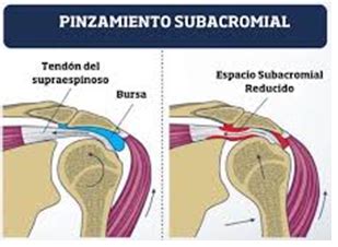 SÍNDROME SUBACROMIAL SÍNDROME DE PINZAMIENTO DEL HOMBRO UNA REVISIÓN