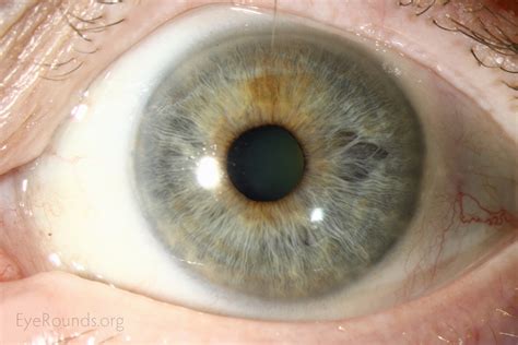 Atlas Entry Ocular Melanocytosis