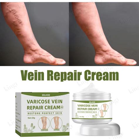 EELHOE Varicose Cream Effective Varicose Vein Treatment Original