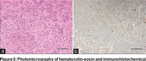 Figure From A Case Of Nonapoplectic Pituitary Adenoma Presenting With