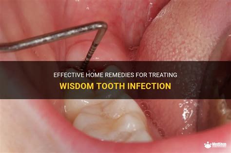 Effective Home Remedies For Treating Wisdom Tooth Infection | MedShun