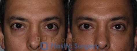 Lower Blepharoplasty With Fat Transfer To Improve The Appearance Of