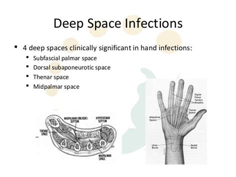 Hand infections