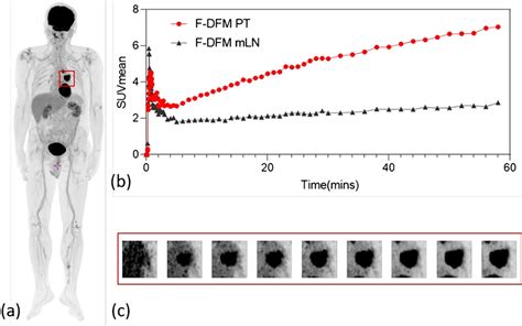 The dynamic ¹⁸F FDG uptake patterns assessed by the 60 min dynamic