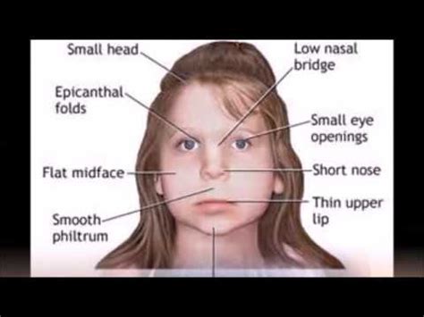 Miller Dieker Syndrome-Causes, Symptoms And Treatment