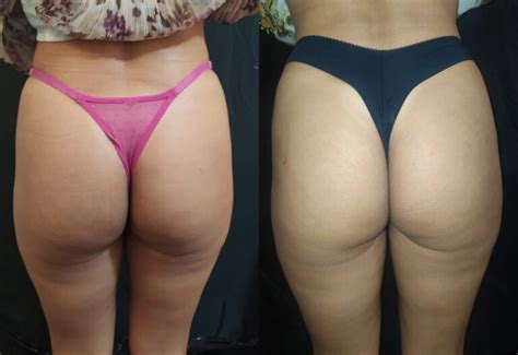 Manchas Escuras Nas Costas Antes E Depois Cl Nica Fit Body Est Tica