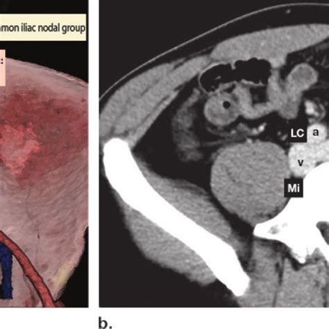 External Iliac Lymph Node Group Illustration A And Axial Download Scientific Diagram