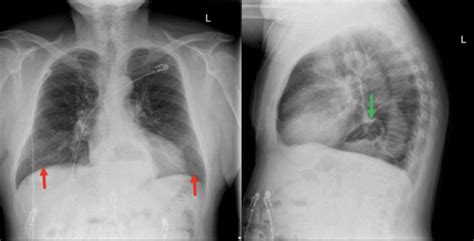 Incidental Hiatal Hernia On Chest X Ray Jetem