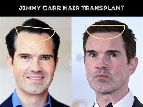 Jimmy Carr Hair Transplant Hair Loss And Technical Analysis