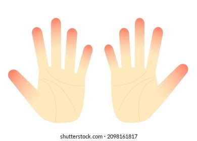 Swollen Finger Stock Illustrations Images Vectors Shutterstock