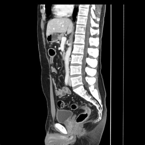 Ulcerative Colitis Image Radiopaedia Org