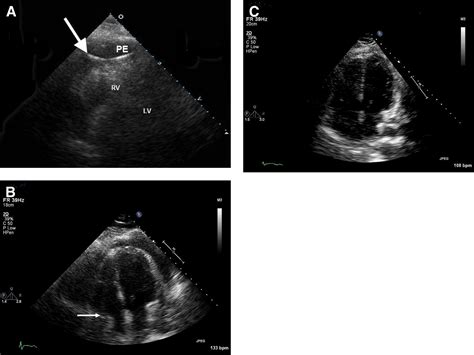 Echocardiography In Pericardial Disease Journal Of The American