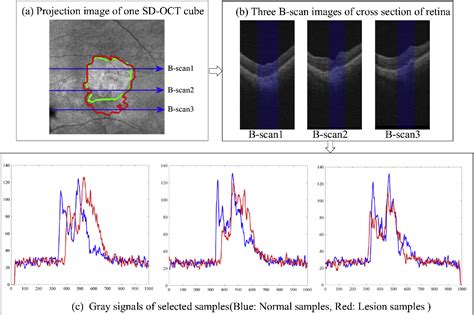 Figure 2 from Automated geographic atrophy segmentation for SD-OCT ...