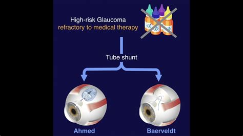 AVB Ahmed Vs Baerveldt Study YouTube