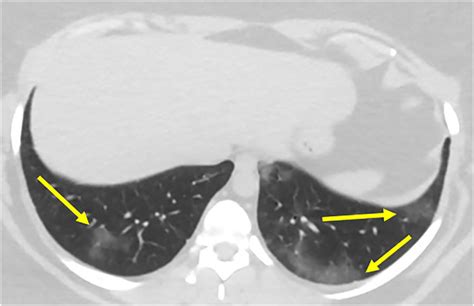 Case 1 Peripheral Ground Glass Opacities In The Lung Bases Arrows Download Scientific