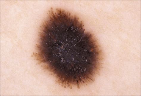 Dermoscopy Of Pigmented Spitz And Reed Nevi Dermatology JAMA