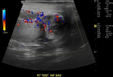 Epididymitis Ultrasound