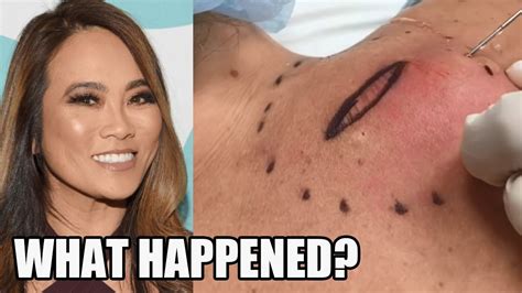 What Happened When Dr Sandra Lee Started Popping Pimples YouTube