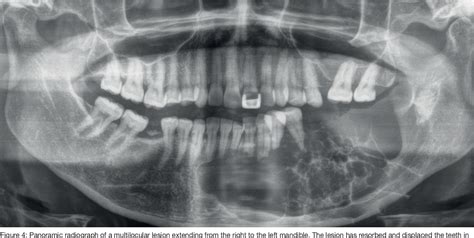 Figure 4 From A 30 Year Review Of Ameloblastoma A Tertiary Hospital