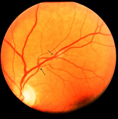 R Tinopathie Hypertensive Diagnostic Par Fond D Oeil Clinique