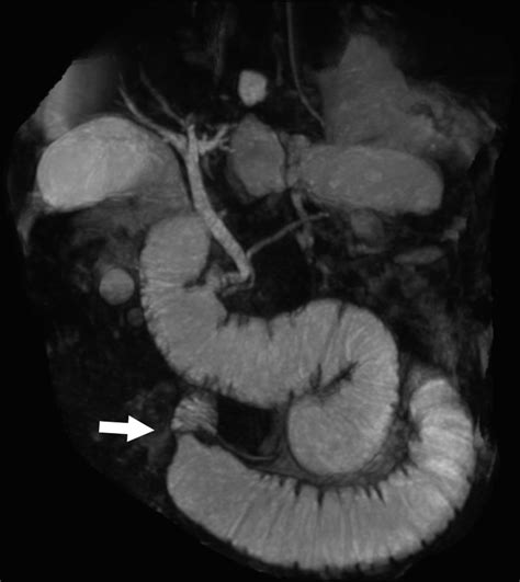 Magnetic Resonance Cholangiopancreatography Showed The Dilated Afferent Download Scientific