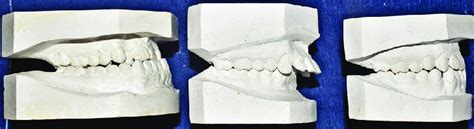 Angles Class I Ii And Iii Right To Left Sagittal Dental Download Scientific Diagram