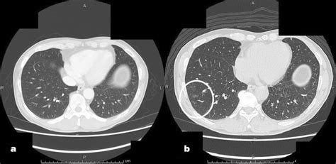 Chest Computed Tomography Scan Findings The Images Show A No Abnormal