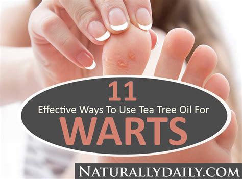 Tea Tree Oil For Warts 11 Effective Ways To Use