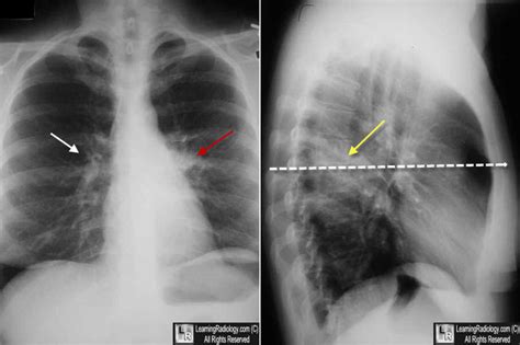 Learning Radiology Dense Hilum Sign