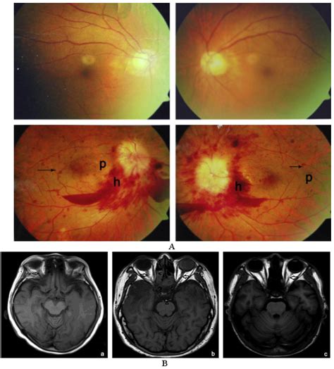 Radiation Therapy Brain Lesions - All About Radiation