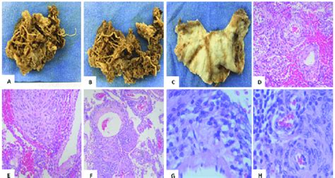 Macro And Microscopic Findings A B Macroscopic Apperance Of The