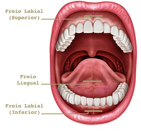 Frenectomia Frenotomia Freios Bucais Dentista Legal