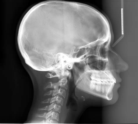 Radiographic Technique Lateral Cephalometric Skull Radiograph Dr Gs Toothpix