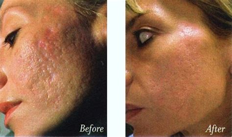 Type Of Acne: What Is Mederma Acne Scars