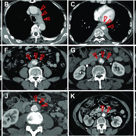 Contrast Enhanced Computed Tomography Findings Of IgG4 Related Aortic