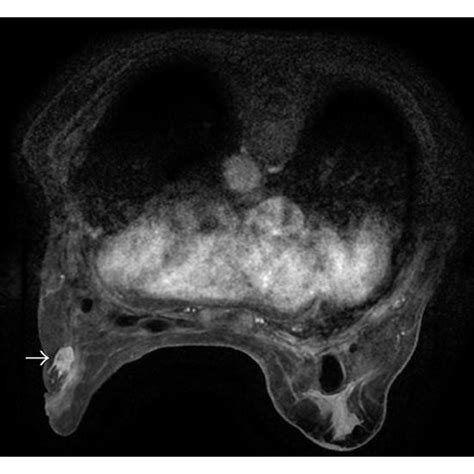 Axial 3d Maximal Intensity Projection Of Enhanced Breast Mri With Fat