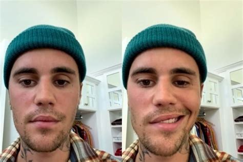 Gq Herpes Z Ster Como O V Rus Da Catapora Afetou O Rosto De Justin