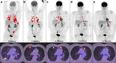 A Patient With New Lesions Despite Declining Whole Body Metabolic Tumor