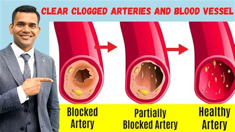 Top 5 Spices To Clean Your Arteries And Blood Vessels And Prevent A