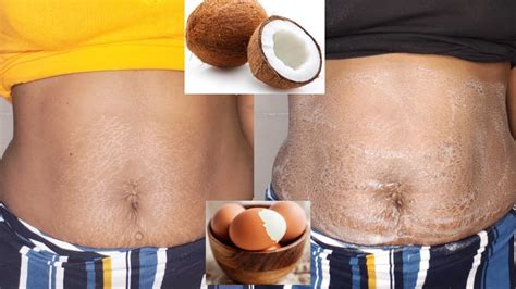 Remove Your Stretch Marks In 3days😱 With Just This Remedy Youtube